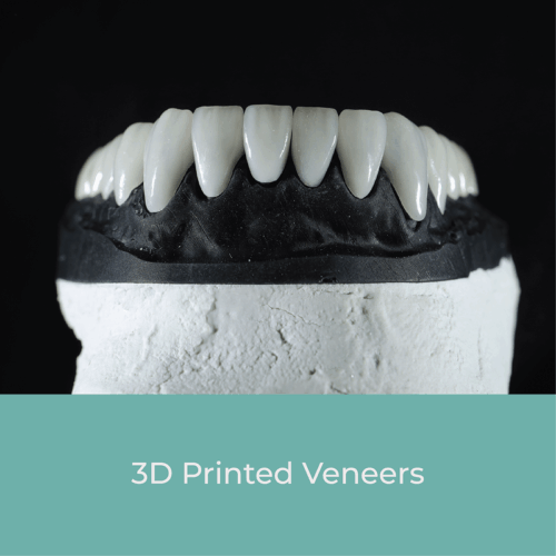 3D printed Veneers