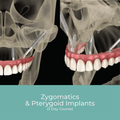 Zygomatics & Pterygoid Implants