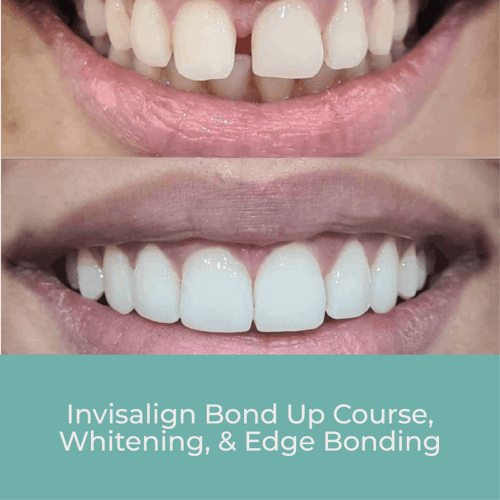 Invisalign Bond Up Course, Whitening, & Edge Bonding
